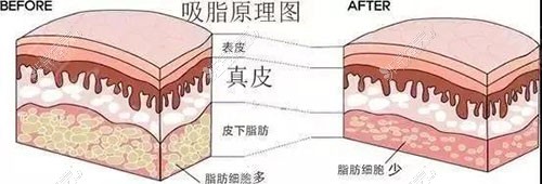 吸脂手術(shù)原理圖