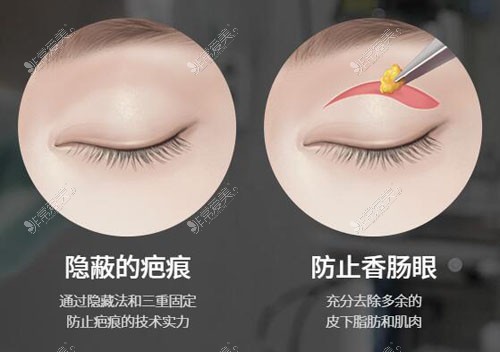 韩国TS整形外科做双眼皮特点分享，眼整形对比差距真大！