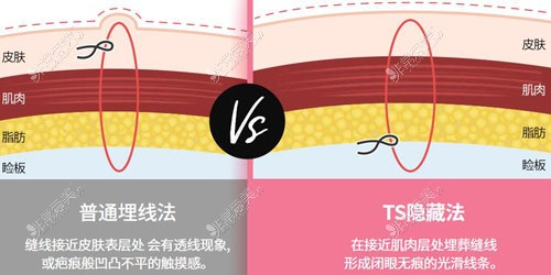 韩国TS整形外科双眼皮手术特点对比