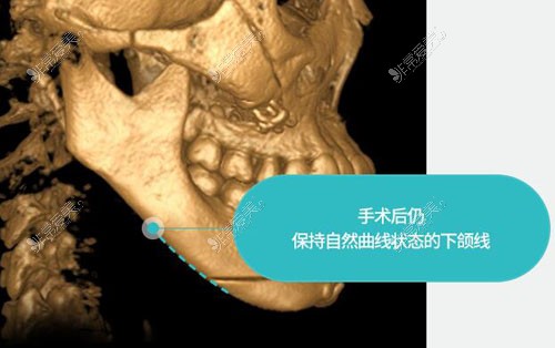 韩国TS整形外科下颌角手术优势介绍