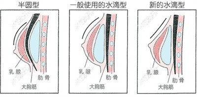 合肥市隆胸假體手術(shù)示意圖