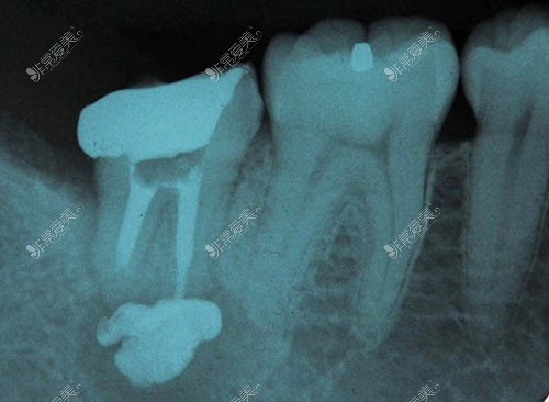 根管治疗后牙齿ct