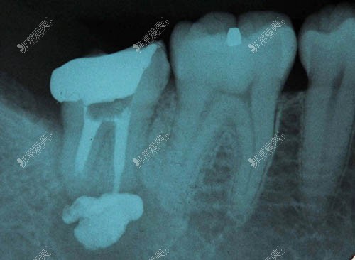 根管治療后牙齒ct