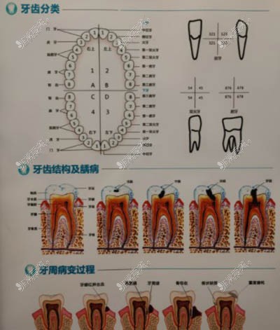 牙齒疾病發(fā)展過程圖