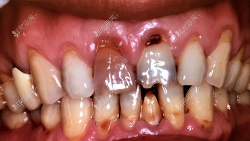 牙齿龋坏照片