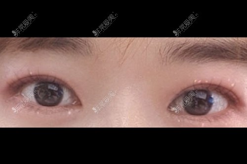 韩国431整形医院眼修复怎么样?整友说双眼皮开眼角修复超好!