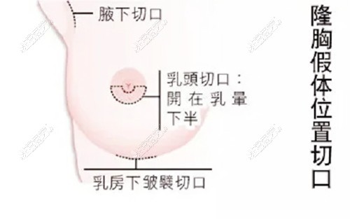 乳房下皱襞切口图示