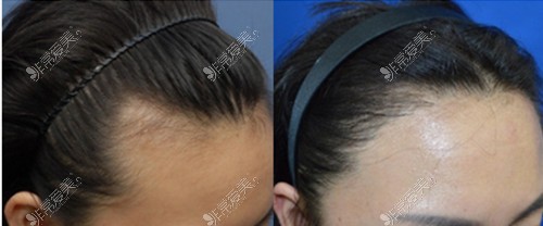 韩国布莱克毛发移植医院女性植发对比