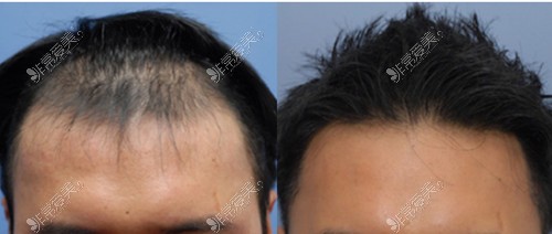 韩国布莱克毛发移植医院男性植发对比
