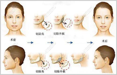 V-LINE瓜子脸手术示意图