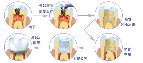 补牙过程