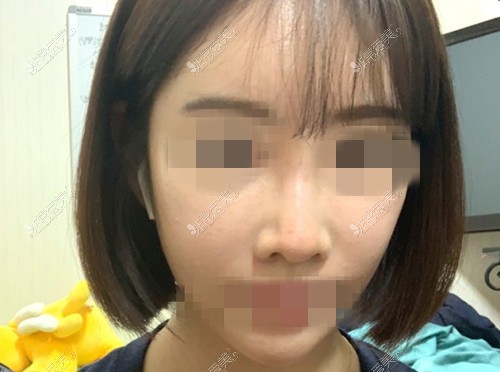 韩国欧佩拉整形外科鼻修复术前照