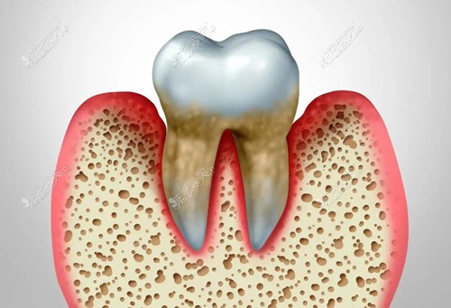 牙周病图示
