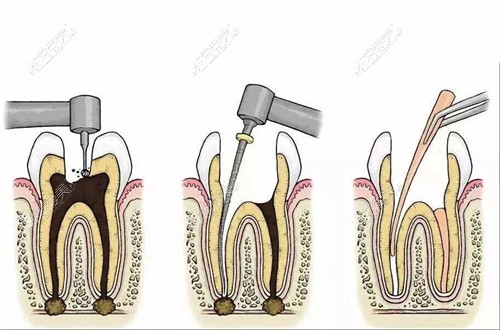 根管治疗示意图