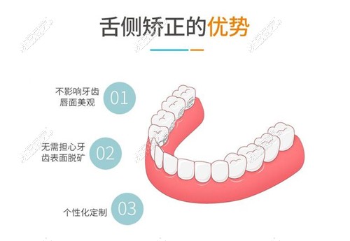 舌侧矫正优势图