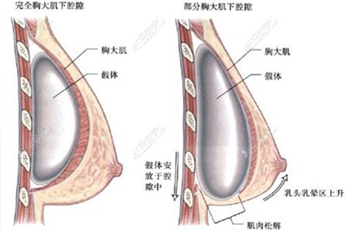 隆胸手術(shù)示意圖