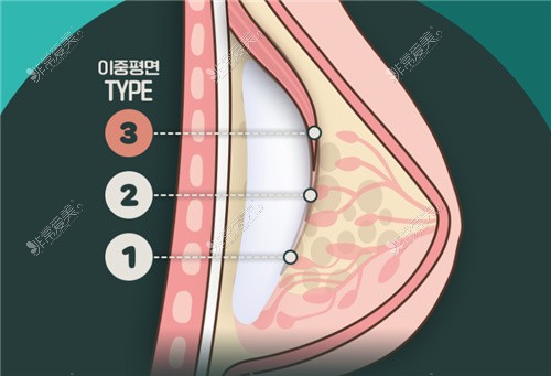 韩国WJ原辰整形外科假体隆胸改善胸部下垂