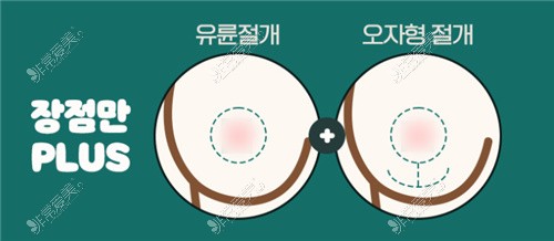 韩国WJ原辰整形外科O型切口及混合型切口