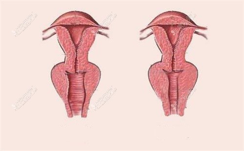 陰道縮緊前后對(duì)比圖