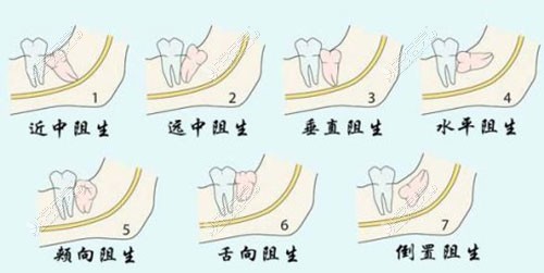 智齒示意圖