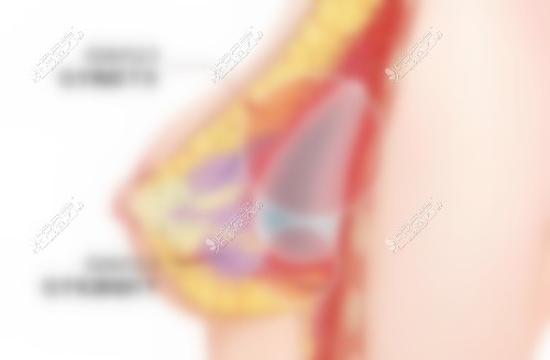 韩国TS整形外科假体植入部位展示图