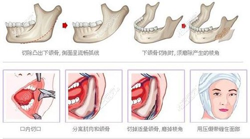 下颌角整形过程示意图