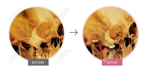 欧佩拉OPERA整形外科颧骨整形方法