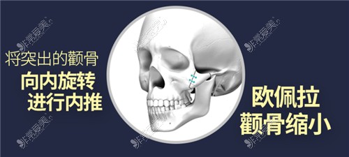 欧佩拉OPERA整形外科颧骨整形方法