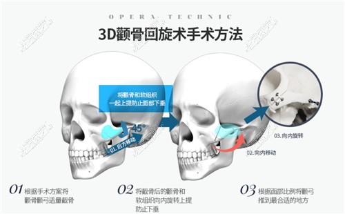 欧佩拉OPERA整形外科颧骨整形手术方式