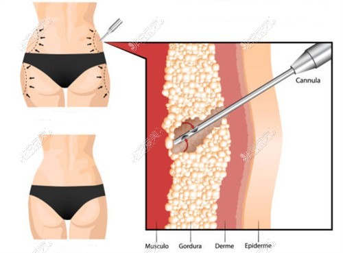 脂肪吸脂手术示意图