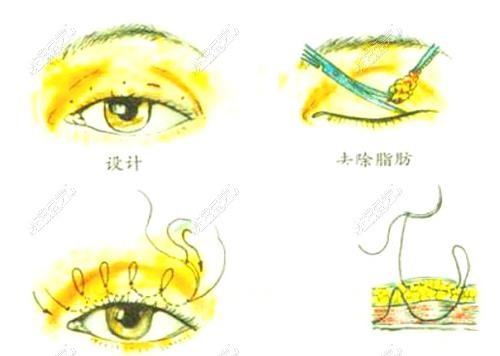 济南艺星整形医院割双眼皮示意图