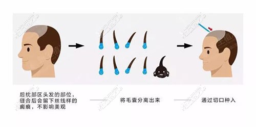 发布苏州植发机构排前十医院,都是植头发比较好的可靠机构