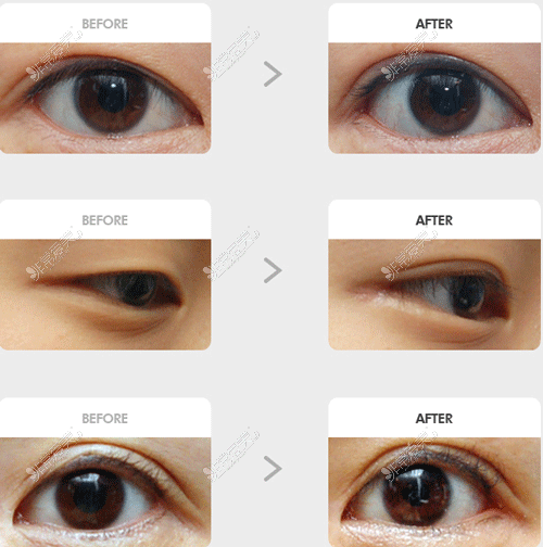 韩国碧夏整形眼睛手术图片