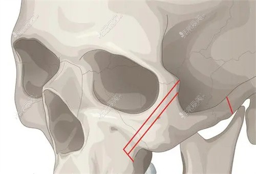 成都西部中西医结合医院颧骨整形术