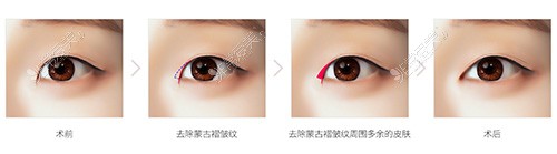 说一说韩国迪美眼角手术功课,不回缩/吊梢眼型矫正做得好!