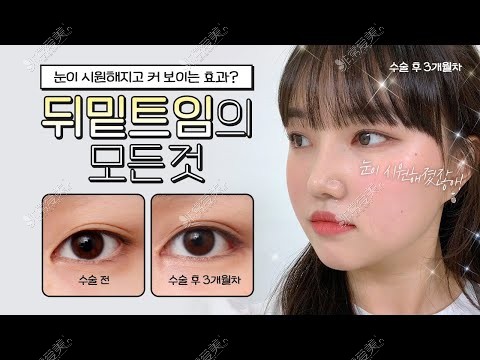 韩国迪美眼角手术实例图