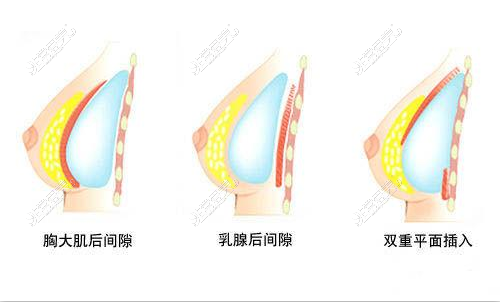 韩国隆胸修复医生推荐，做隆胸失败修复手术找他们准没错
