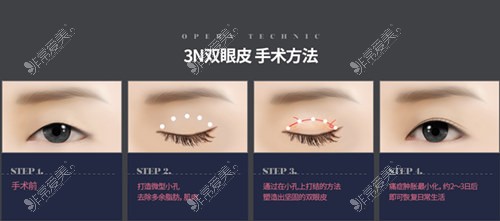 3N双眼皮手术解析