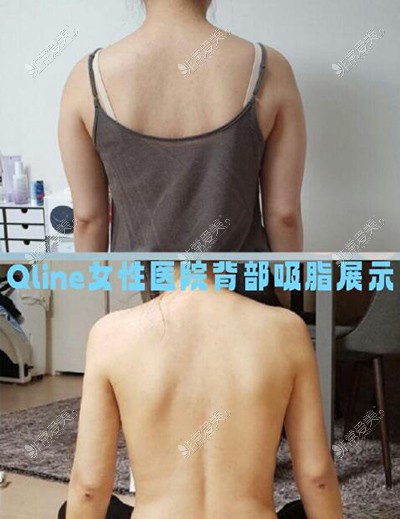 韩国Qline女性医院背部吸脂展示