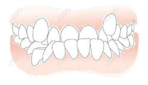 牙齿歪斜示意图