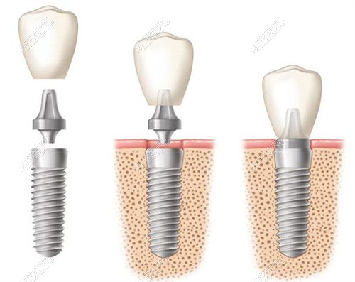 种植牙示意图