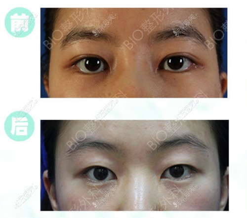 韩国辛容镐双眼皮改单眼皮和双眼皮修复都厉害,附日记对比!