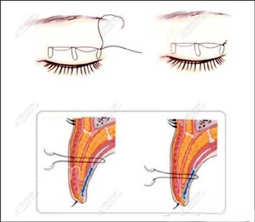 双眼皮手术图示