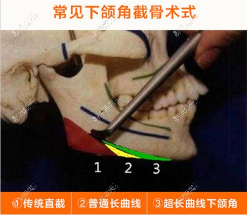 常见的下颌角截骨方式