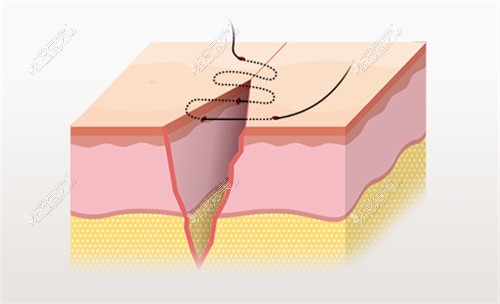 皮肤缝合示意图