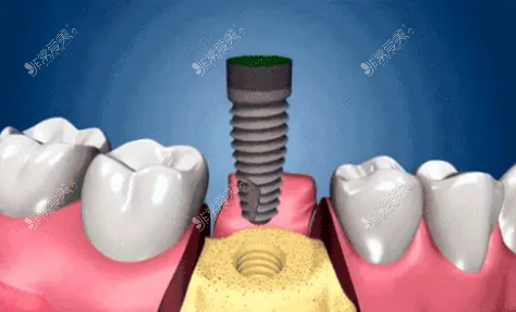 种植牙过程图片