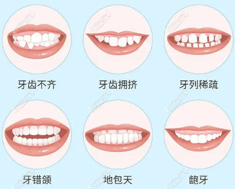 需要矫正的牙齿情况分类