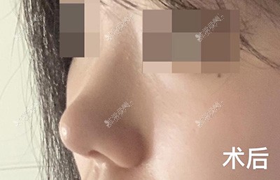 韩国欧佩拉鼻翼手术后一个月