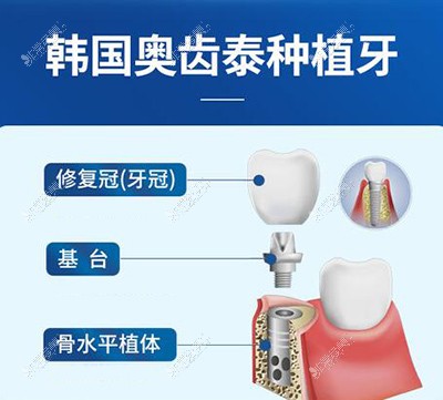 韩国奥齿泰种植牙