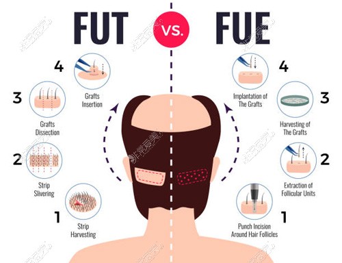 FUT植发和FUE植发方式对比